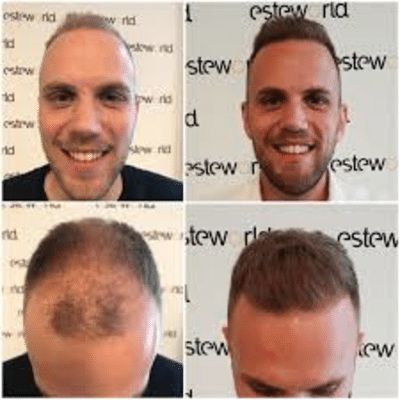 Zeg vaarwel tegen kaalhoofdigheid dankzij een haartransplantatie van Esteworld